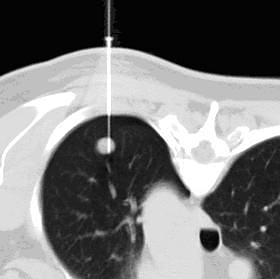 Minimalinvasive Biopsie eines Lungentumors