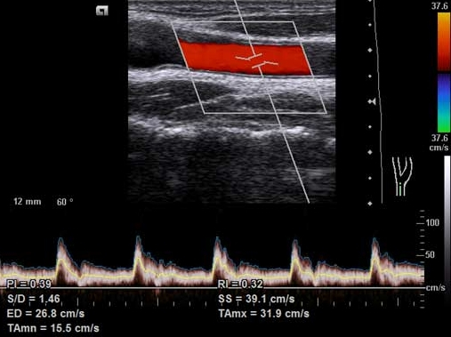 Duplexsonographie der Beinarterien